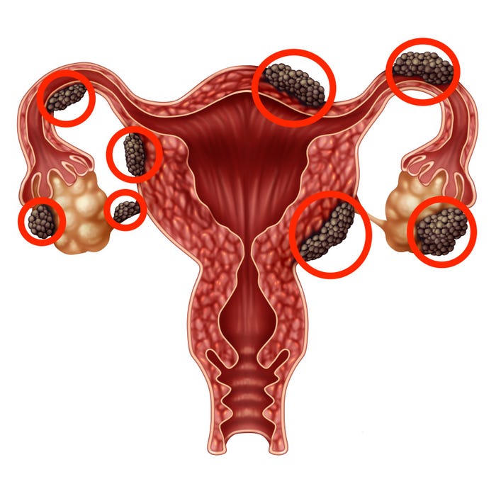 endometriozis belirtileri