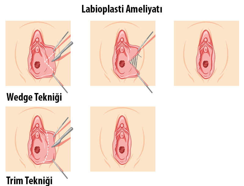 Labioplasti ameliyatı