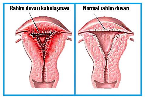 rahim duvarı kalınlaşması