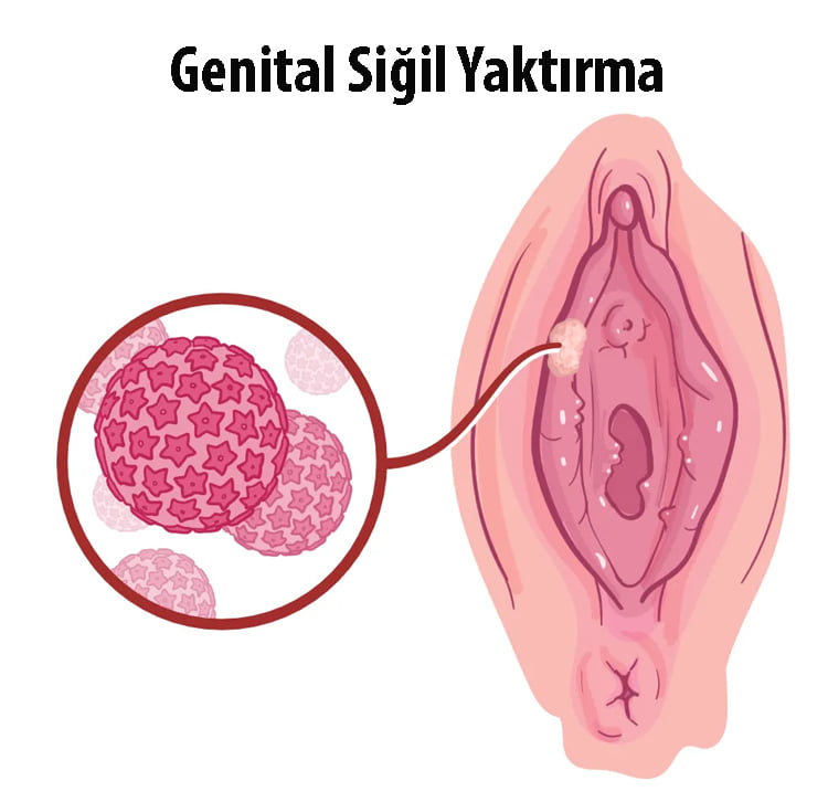 siğil yaktırma işlemi