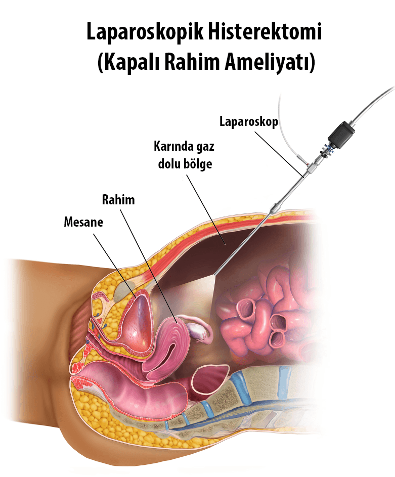 kapalı rahim alma ameliyatı